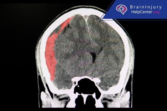 traumatic brain injury treatment